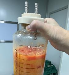 渭南水动力吸脂手术要做多久？